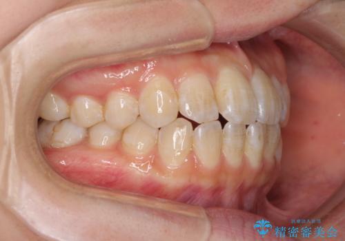 気になる前歯のデコボコ　インビザラインによる矯正治療の治療中