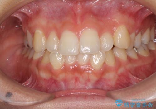 前歯の突出感とデコボコ インビザラインで改善の治療前