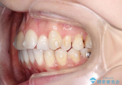 インビザラインによる非抜歯での八重歯の矯正　の治療中