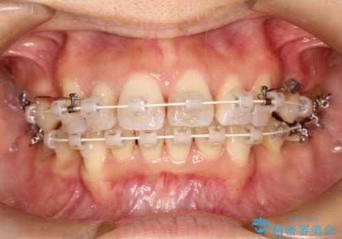 ワイヤーによる抜歯矯正でガタガタと深いかみ合わせの改善の治療中