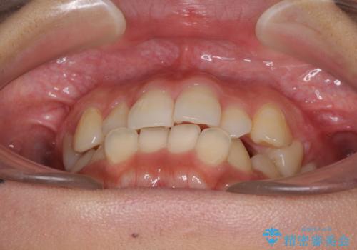 前歯の突出感とデコボコ　インビザラインで改善の治療前