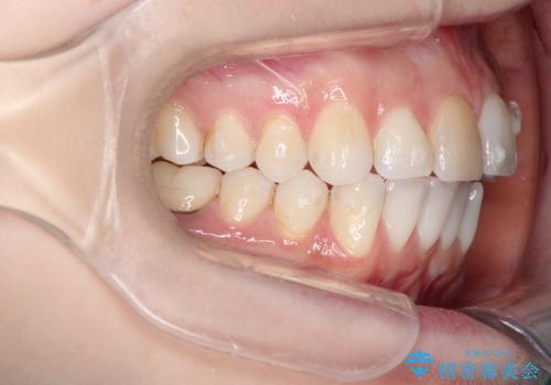 インビザラインによる非抜歯での八重歯の矯正 の治療中