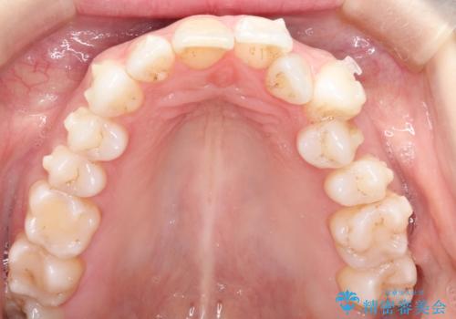 インビザラインによる非抜歯での八重歯の矯正　の治療中