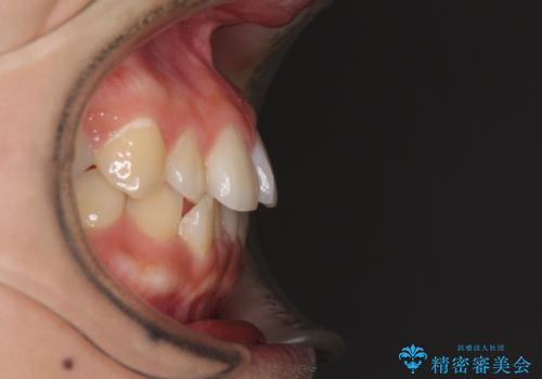 前歯の突出感とデコボコ インビザラインで改善の治療前