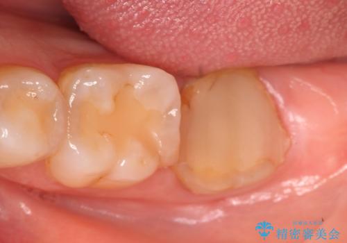 歯冠延長術 他院にてクラウンが入れられないと言われた歯の治療の治療前