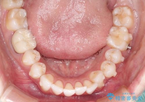 インビザラインによる非抜歯での八重歯の矯正 の治療中