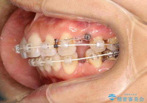 ワイヤーによる抜歯矯正でガタガタと深いかみ合わせの改善の治療中