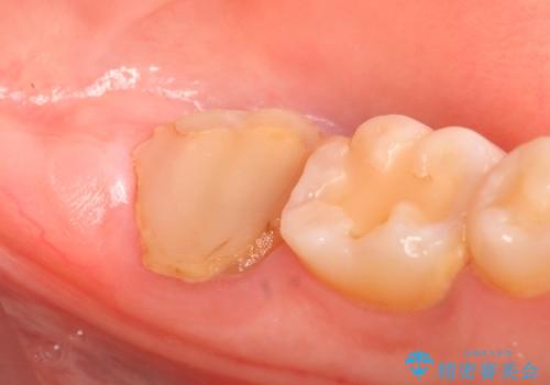 歯冠延長術 他院にてクラウンが入れられないと言われた歯の治療の治療前