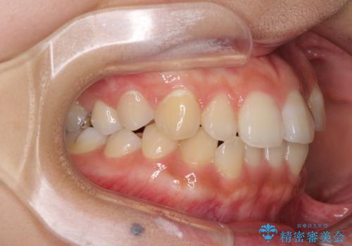 前歯の突出感とデコボコ インビザラインで改善の治療前