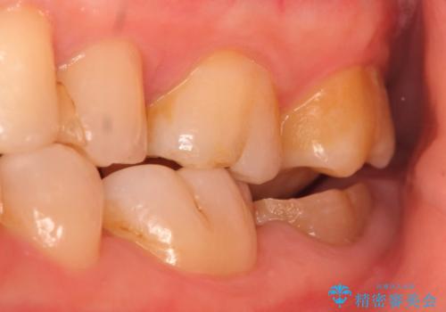 歯冠延長術　他院にてクラウンが入れられないと言われた歯の治療の治療前