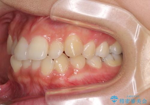 前歯の突出感とデコボコ インビザラインで改善の治療前