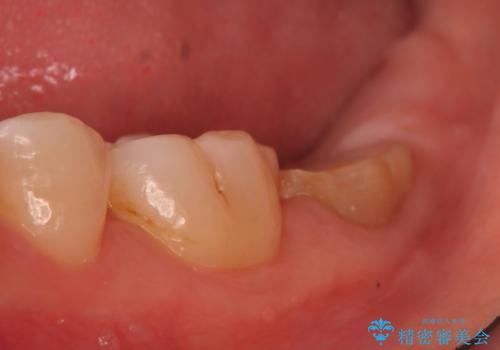 歯冠延長術　他院にてクラウンが入れられないと言われた歯の治療の症例 治療前