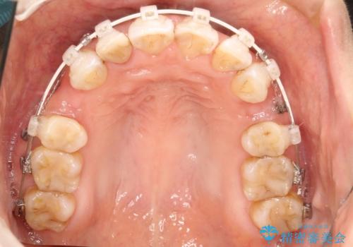 ワイヤーによる抜歯矯正でガタガタと深いかみ合わせの改善の治療中