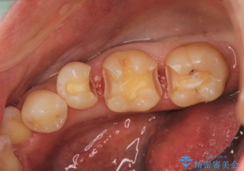 歯と歯の間に食べ物がつまる、金属を白くしたい、セラミックインレーにて修復の治療中