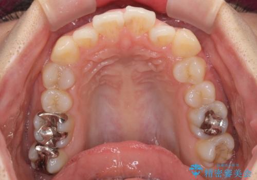 前歯の突出感とデコボコ　インビザラインで改善の治療前