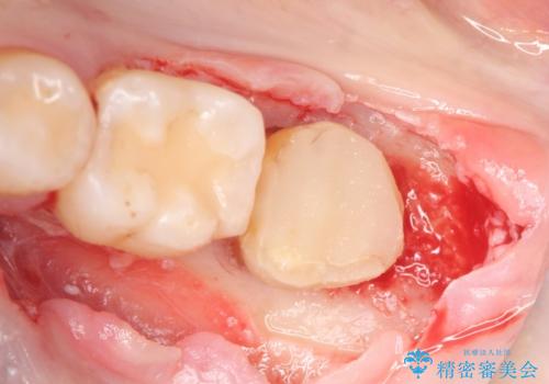 歯冠延長術　他院にてクラウンが入れられないと言われた歯の治療の治療中