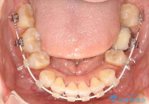 ワイヤーによる抜歯矯正でガタガタと深いかみ合わせの改善の治療中