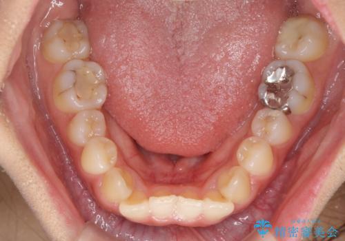 前歯の突出感とデコボコ インビザラインで改善の治療前