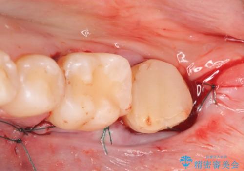 歯冠延長術 他院にてクラウンが入れられないと言われた歯の治療の治療中