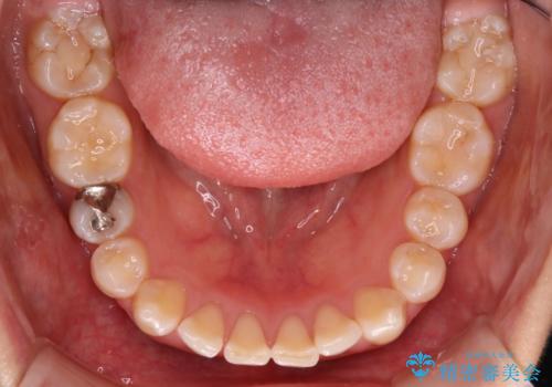 【ワイヤー矯正】前歯が出てるのをなおしたい。の治療前