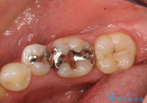 歯と歯の間に食べ物がつまる、金属を白くしたい、セラミックインレーにて修復の症例 治療前