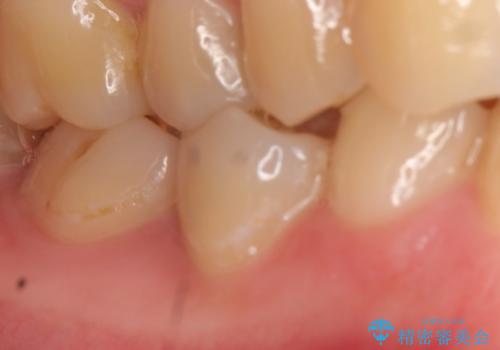 オールセラミッククラウン ズキズキ痛む虫歯の治療の治療前