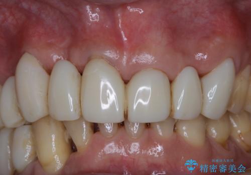 治療中にPMTCでメンテナンス