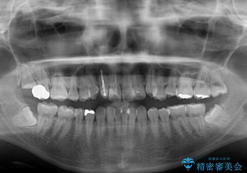 狭い上顎骨を拡大　インビザラインによる非抜歯矯正の治療前