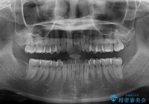 前歯のデコボコを解消 インビザラインによる矯正治療の治療前