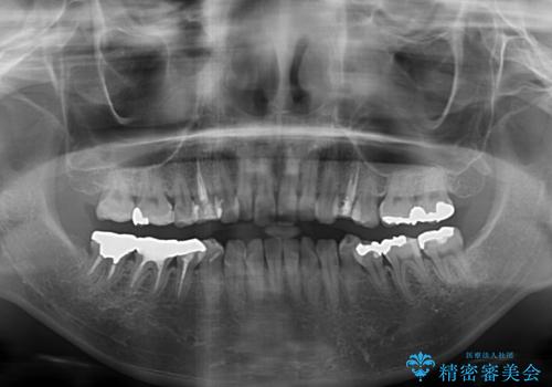 総合歯科治療　矯正治療と失活歯のセラミック補綴治療の治療前