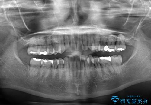 八重歯のインビザライン矯正治療の治療前
