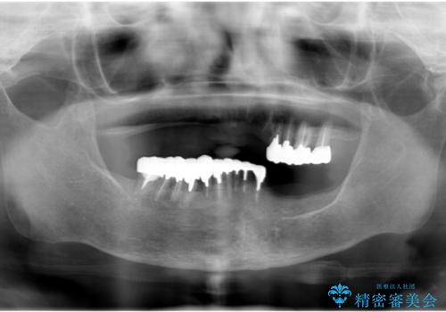 インプラントオーバーデンチャー 咬合平面の改善の治療前