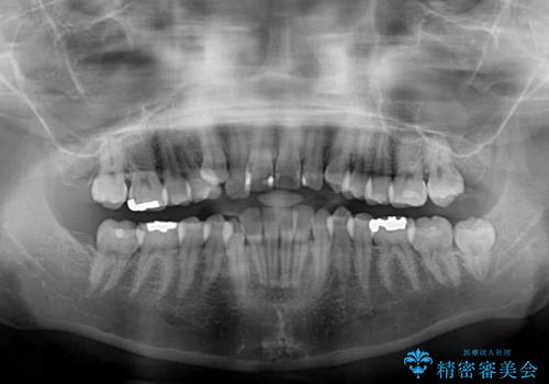 上下の八重歯を治したい インビザラインと補助装置を用いた抜歯治療の治療前