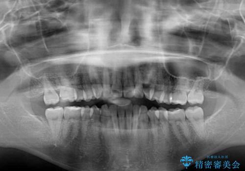 全く目立たないワイヤー矯正 上下リンガル矯正の治療前
