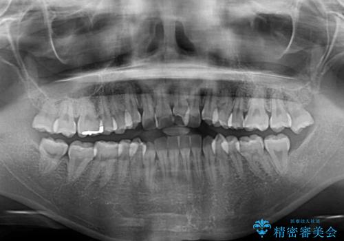 前歯のクロスバイトを治したい インビザラインによる矯正治療の治療前