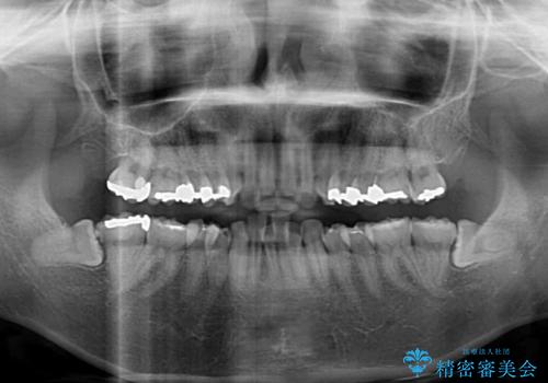 閉じにくい口元 前歯を引っ込める抜歯矯正の治療前
