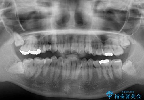 前歯の突出感とデコボコ インビザラインで改善の治療前