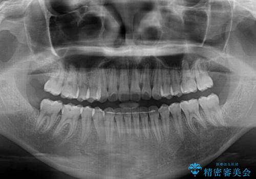 オープンバイトでかみにくい　インビザラインによる矯正治療の治療後