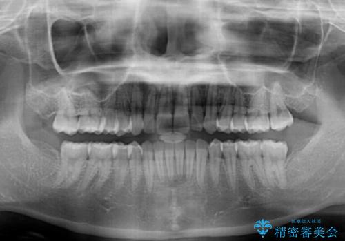 前歯のデコボコを解消　インビザラインによる矯正治療の治療後