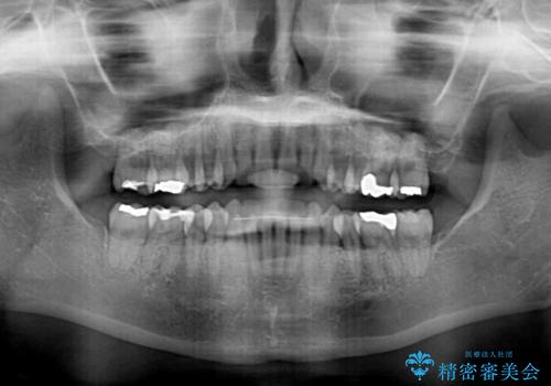 八重歯のインビザライン矯正治療の治療後