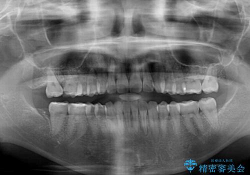 全く目立たないワイヤー矯正 上下リンガル矯正の治療後