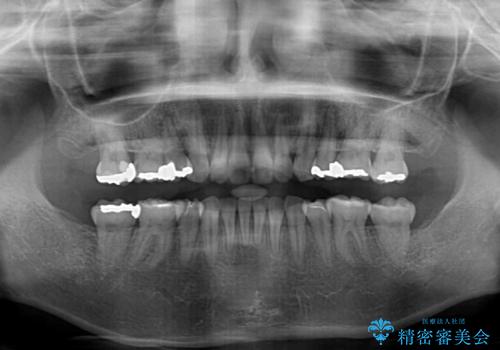 閉じにくい口元　前歯を引っ込める抜歯矯正の治療後
