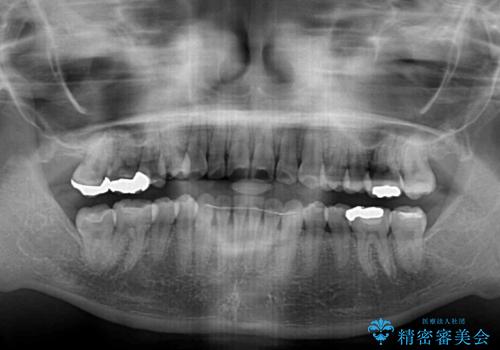 前歯の突出感とデコボコ インビザラインで改善の治療後