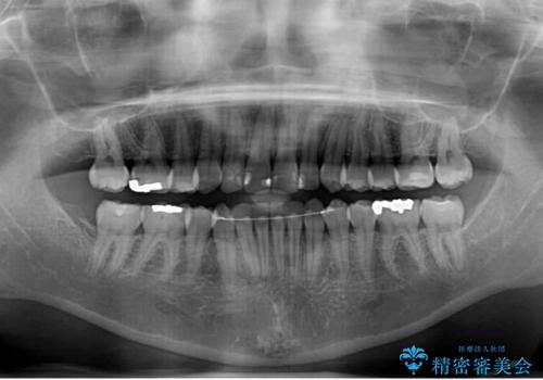 上下の八重歯を治したい　インビザラインと補助装置を用いた抜歯治療の治療後