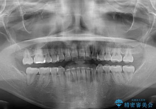 前歯のクロスバイトを治したい インビザラインによる矯正治療の治療後