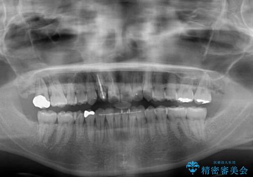 狭い上顎骨を拡大 インビザラインによる非抜歯矯正の治療後