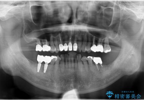 奥歯が割れてしまった　インプラントでかめるように　全体的な治療もの治療後