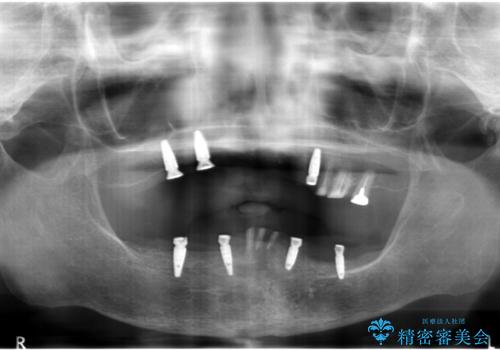 インプラントオーバーデンチャー 咬合平面の改善の治療後