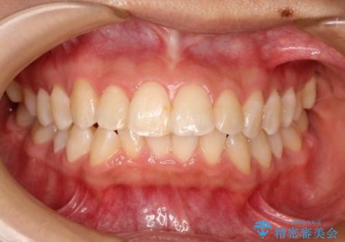【非抜歯矯正】できる限り前歯を引っ込めたいの症例 治療前