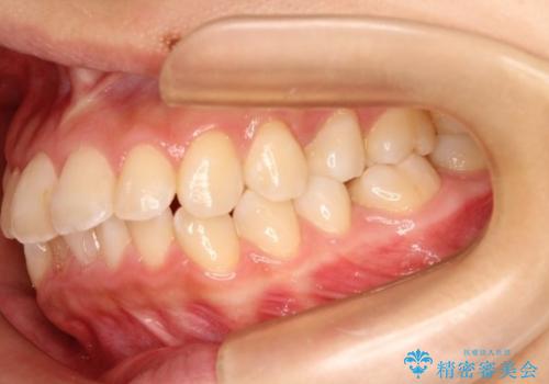 【非抜歯矯正】できる限り前歯を引っ込めたいの治療前